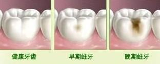 长沙龋齿危害